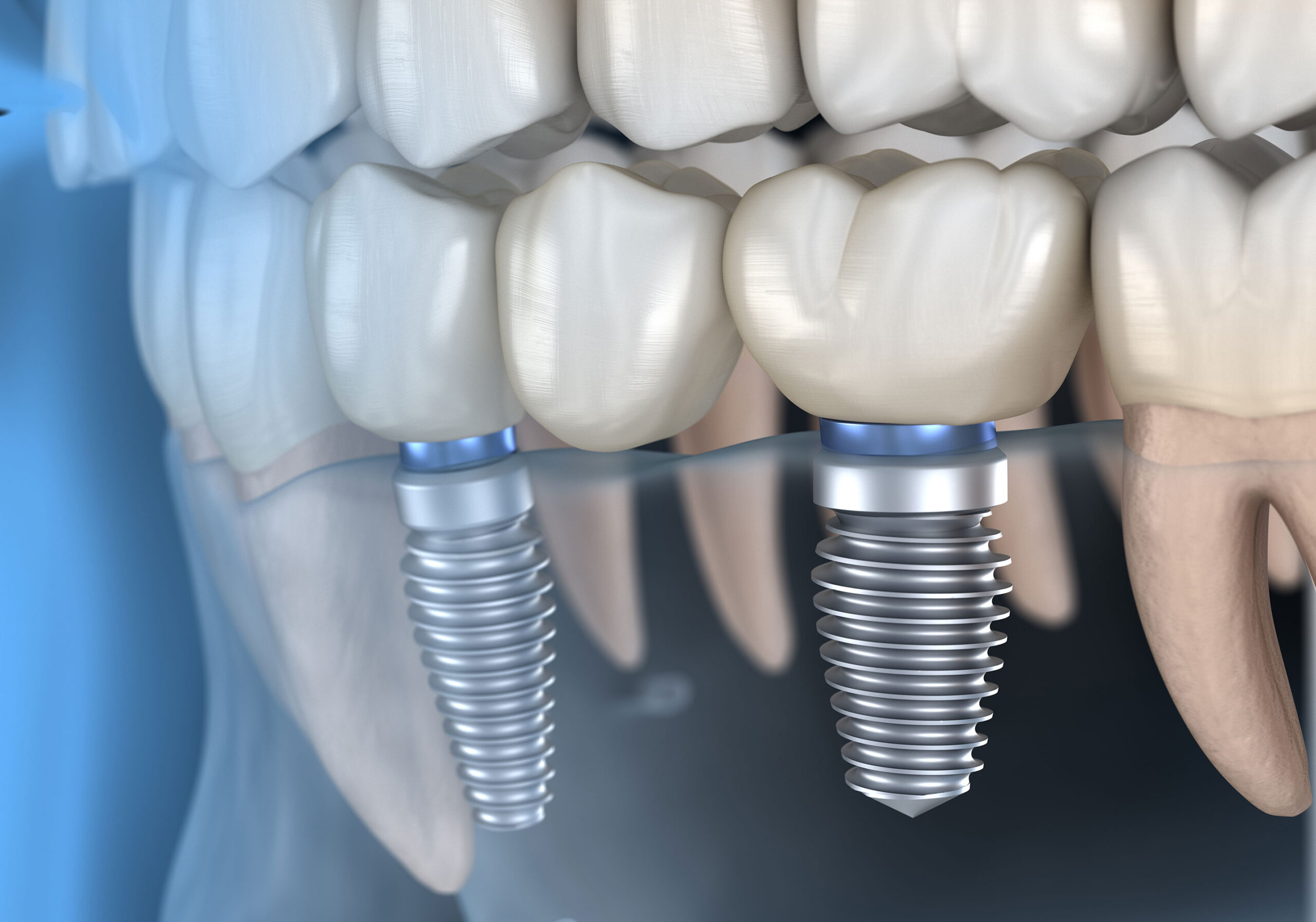 https://lynton.expressionsdental.co.uk/wp-content/uploads/2022/09/dental-implants-scaled.jpg
